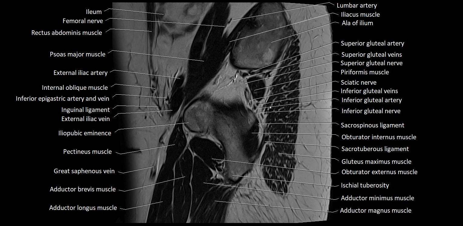 Sagittal cross sectional anatomy of female pelvis (MRI 3T) image 4.webp